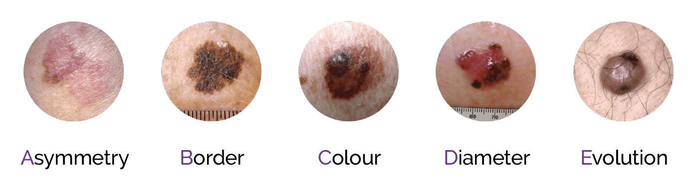 ABCDE of moles