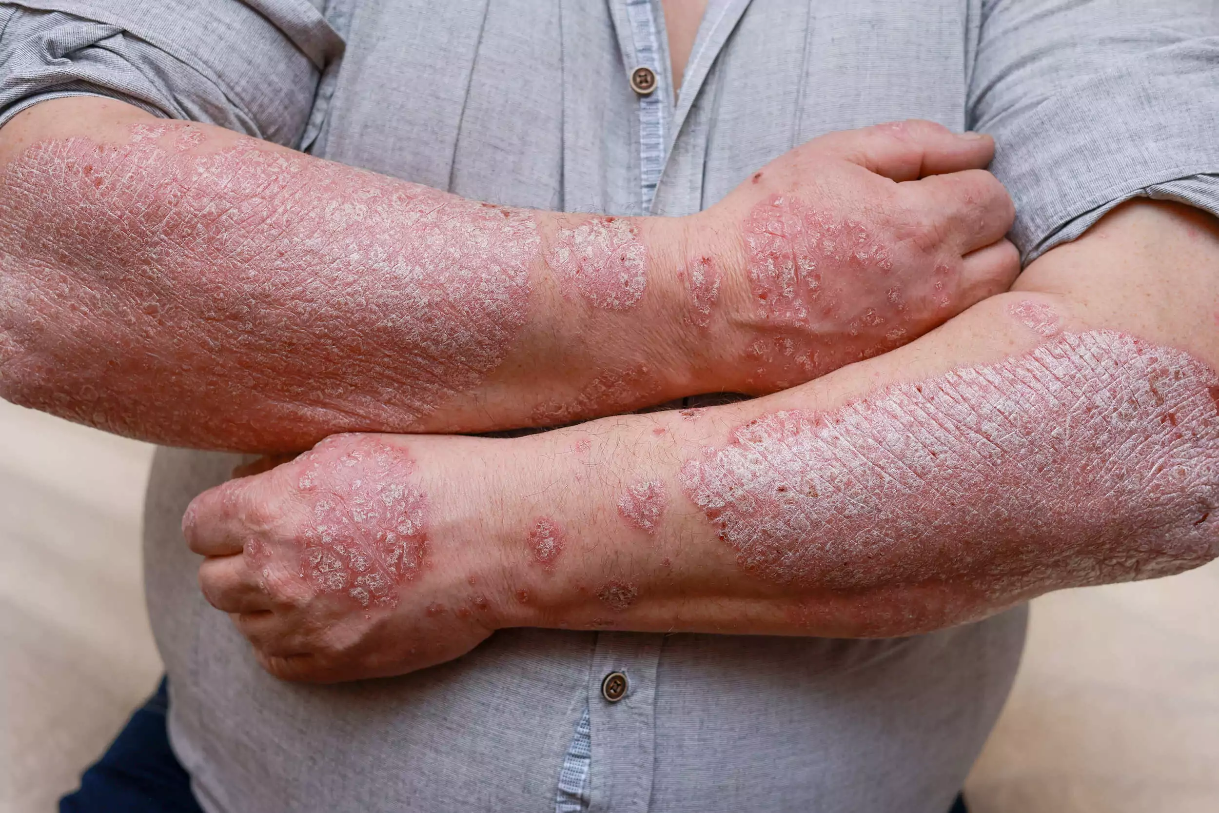 Image severe psoriasis