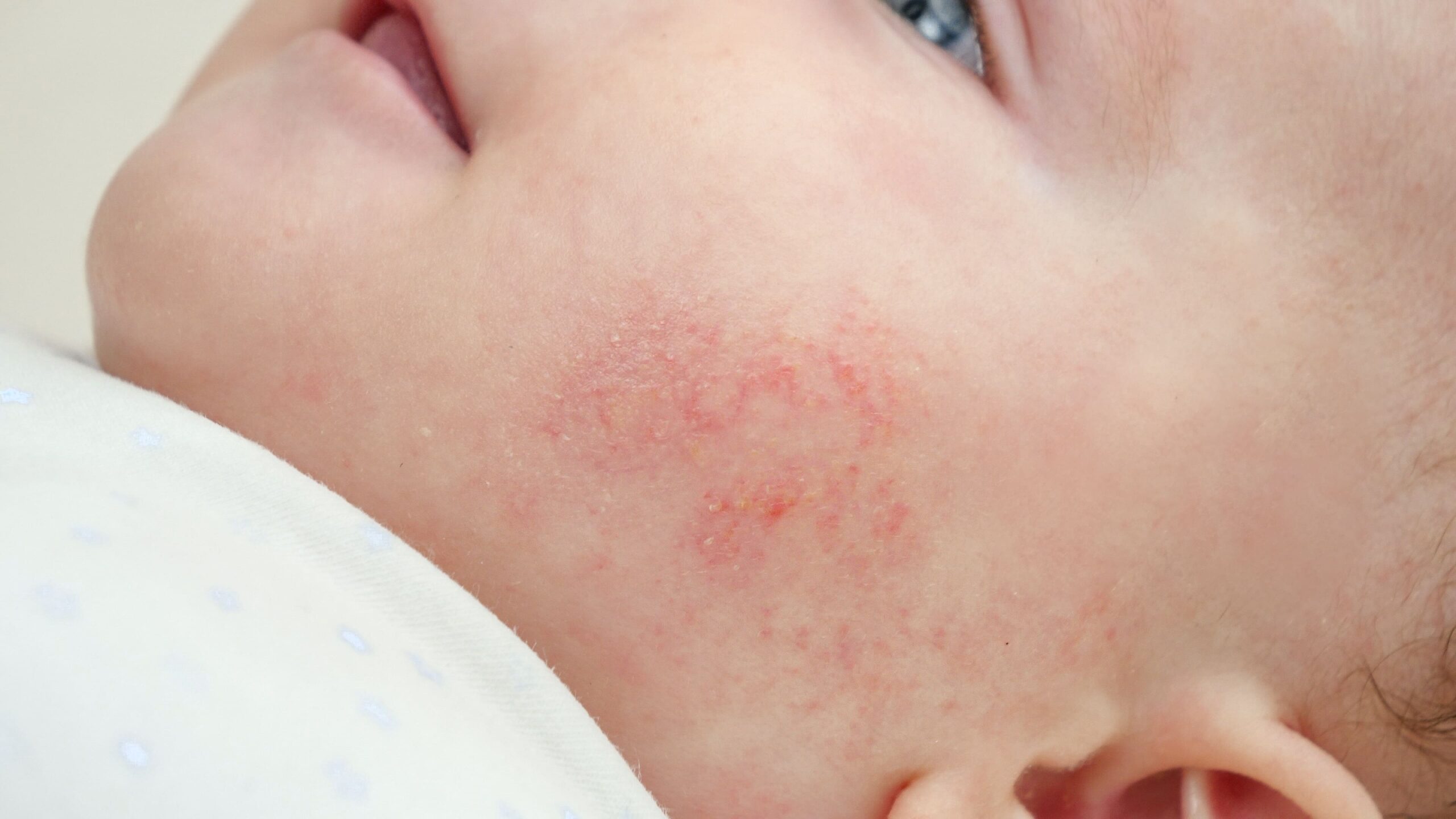 Newborn Rash Treatment | Dermatology Care in Singapore