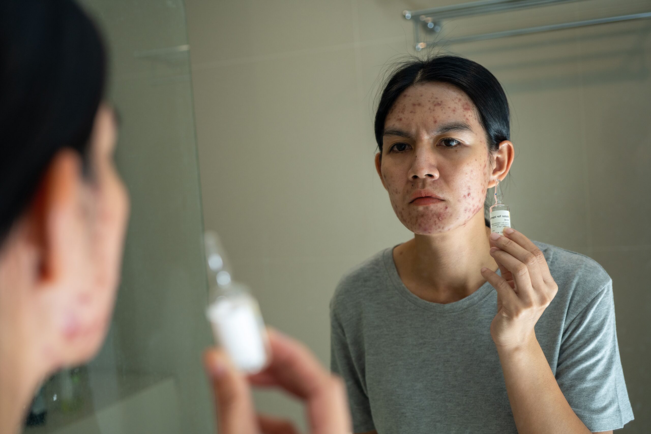 Image acne on face because the disorders of sebaceous gl 2026 01 07 02 09 17 utc (1)