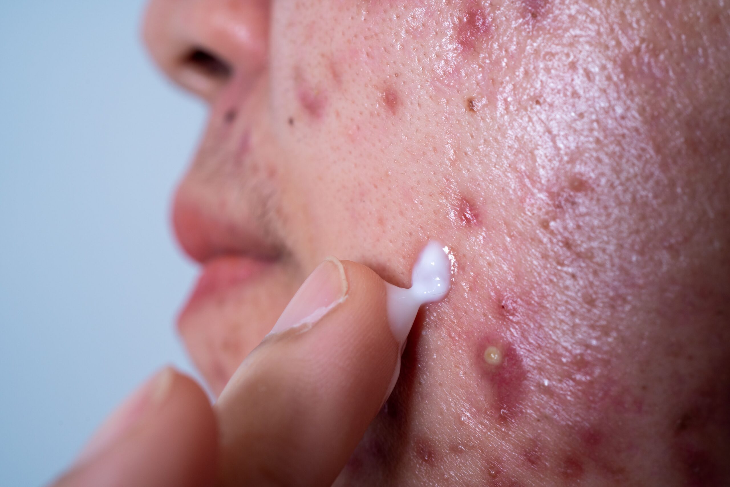 Image acne on face because the disorders of sebaceous gl 2026 03 09 00 15 17 utc (2)