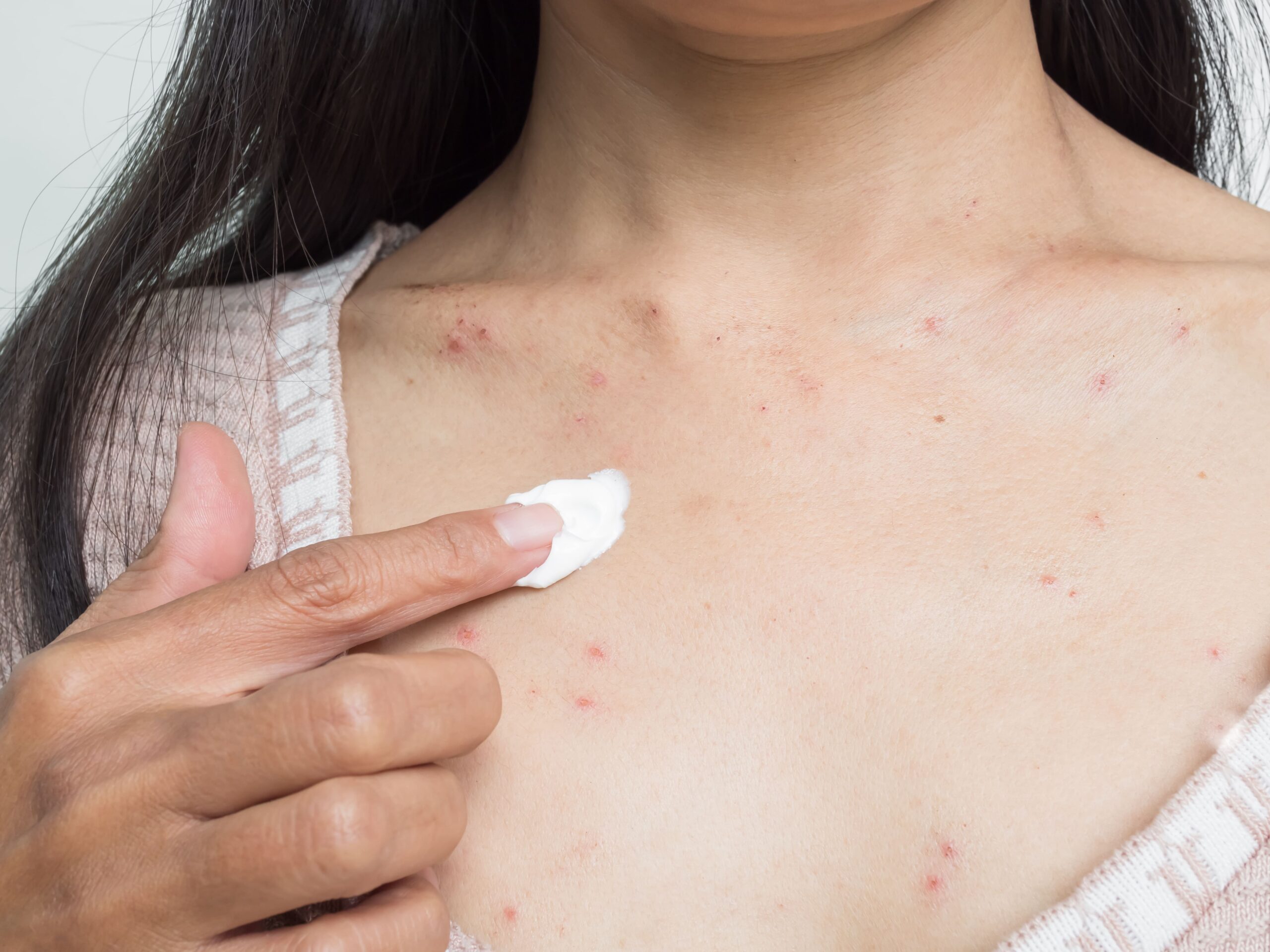 Image woman with urticaria allergy itchy rash eczema itc 2026 01 09 00 10 03 utc (1)