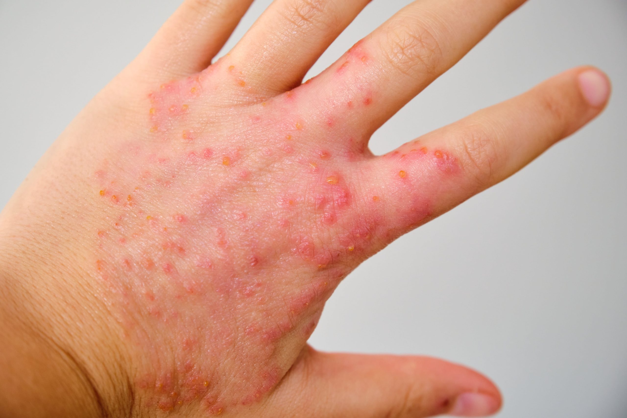 A close-up view of a hand affected by eczema, showing red, inflamed skin with small bumps.