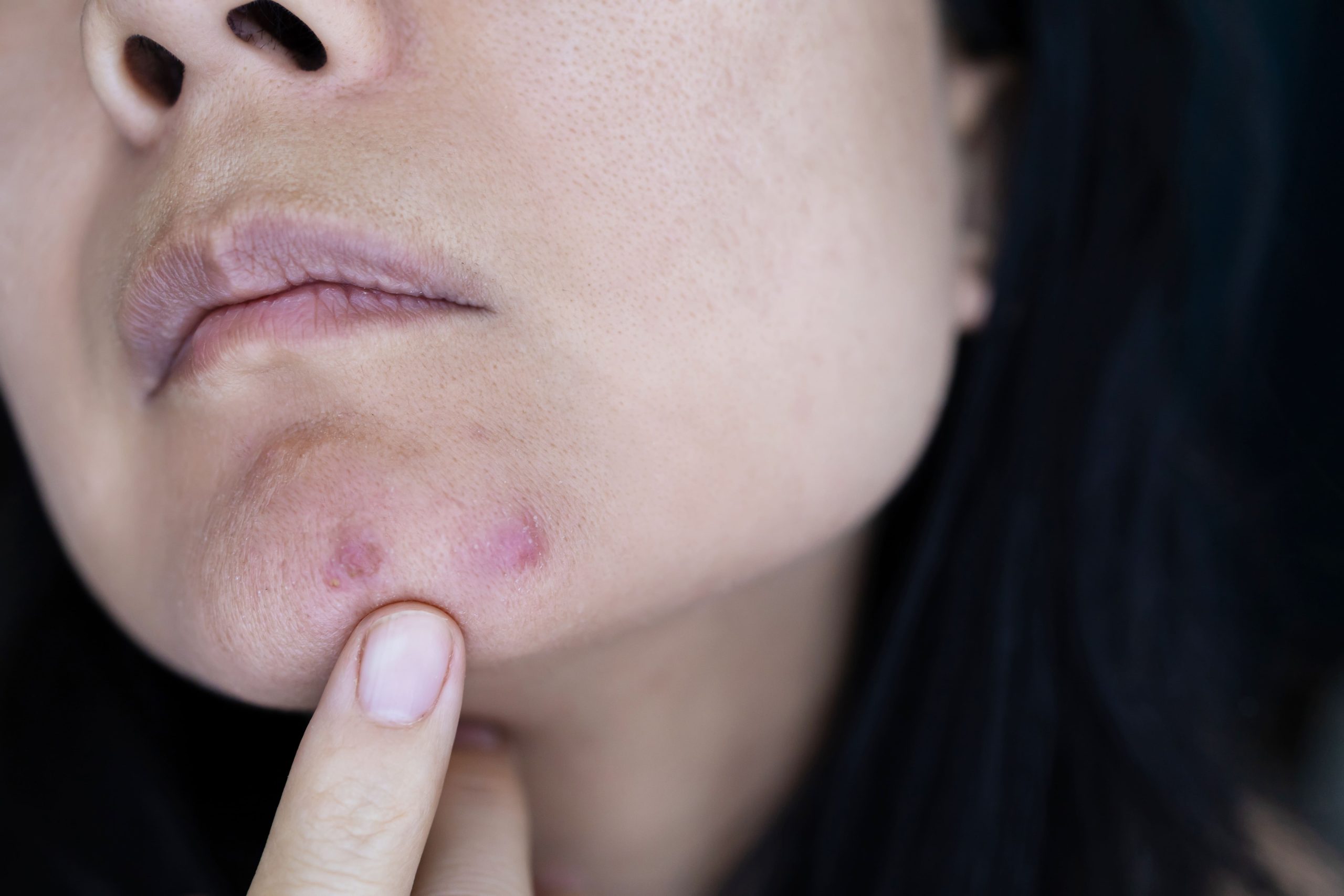 A close-up view of a woman's face highlighting areas with acne on her cheek and chin.