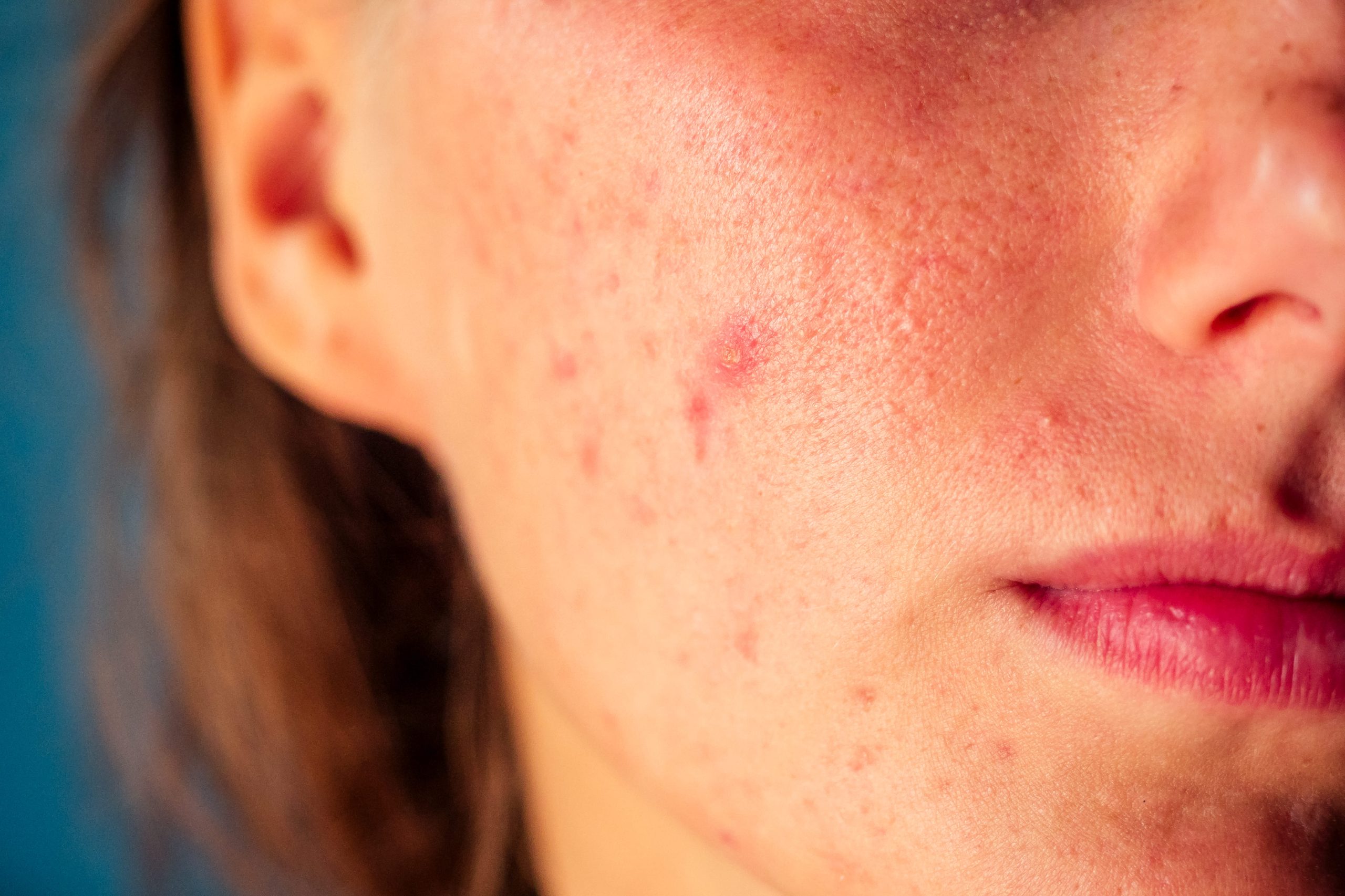 Close-up of a person's face showing post-acne scars and red pimples.